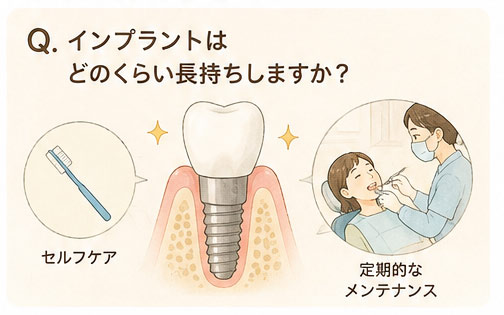 Q. インプラントはどのくらい長持ちしますか？